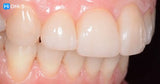 The Index Technique. No-prep worn dentition treatment
