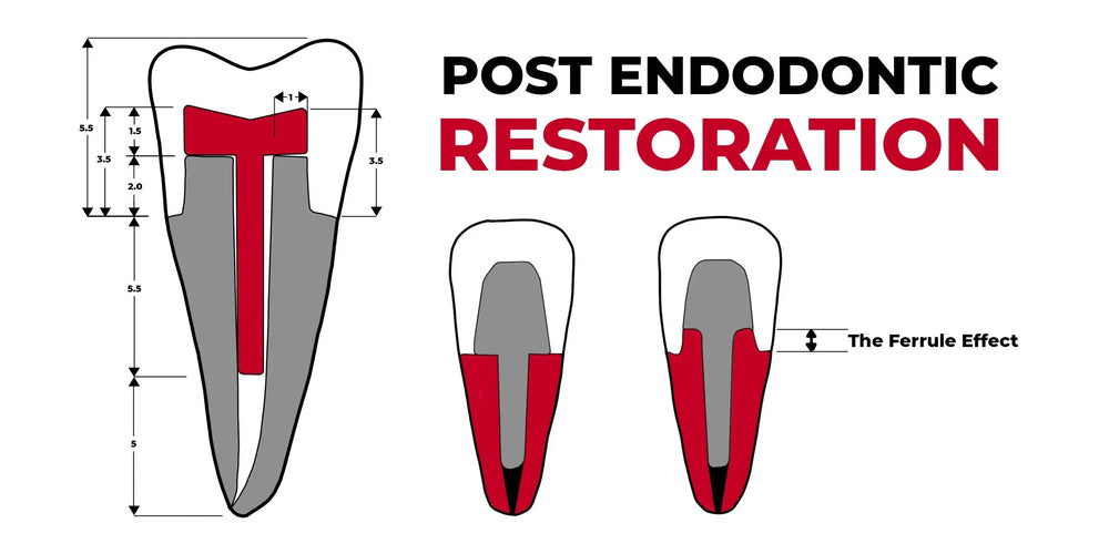 Post Endodontic Restoration: from root canal preparation to occlusal check