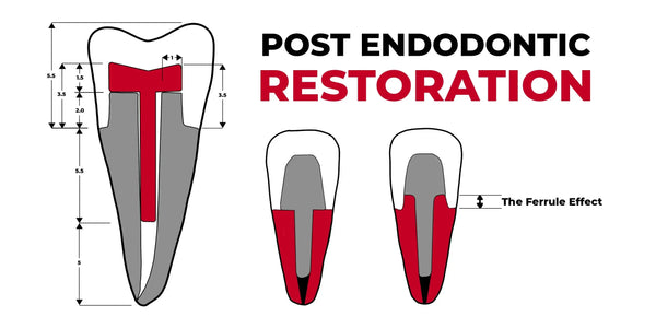 Post Endodontic Restoration: from root canal preparation to occlusal check