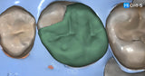 All‑Digital Workflow: Protocols for Flawless Indirect Restorations