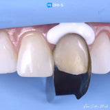 The Biomimetic Concept: Composite Restoration Protocols