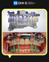 Implant‑Retained Dentures: Innovative Approaches to Full‑Arch Prosthetics