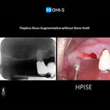 Predictable Sinus Lift