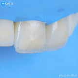 The Biomimetic Concept: Composite Restoration Protocols
