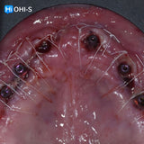 Removable dentures for dentists and technicians