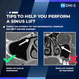 Predictable Sinus Lift