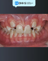 Early Orthodontic Treatment: When and How?