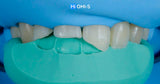International Schools Working with Composite Restorations