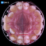 Damon 2.0. How to treat all common malocclusions