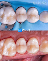 The Biomimetic Concept: Composite Restoration Protocols