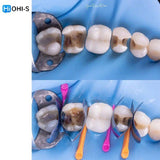 The Biomimetic Concept: Composite Restoration Protocols