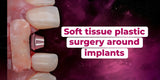 Soft Tissue Plastic Surgery around Implants