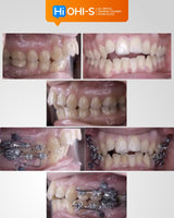 Biomechanics in Orthodontics