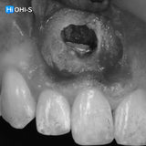 Apical Surgery: For Endodontists and Surgeons