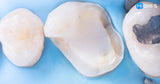 All‑Digital Workflow: Protocols for Flawless Indirect Restorations