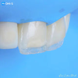 The Biomimetic Concept: Composite Restoration Protocols