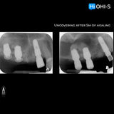 Predictable Sinus Lift