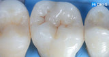 International Schools Working with Composite Restorations
