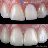 The Biomimetic Concept: Composite Restoration Protocols