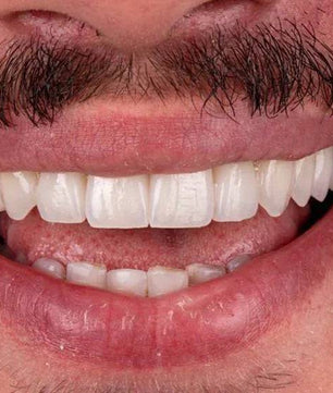 Ceramic Layering: Protocols of the World’s Leading Schools - Dental Courses | كورسات طب اسنان