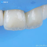 The Biomimetic Concept: Composite Restoration Protocols
