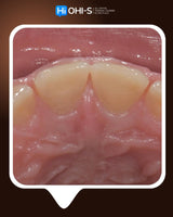 Dental Trauma Without Drama
