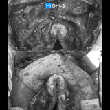 Bone Augmentation: Current Techniques