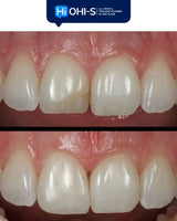 Anterior Veneers: Digital Manufacturing Protocols for Functional and Aesthetic Restorations