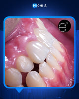 Anterior Aesthetics: The Complete Composite Guide