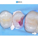 The Biomimetic Concept: Composite Restoration Protocols