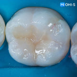 International Schools Working with Composite Restorations