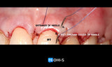 Advanced Periodontology: Surgical Protocols