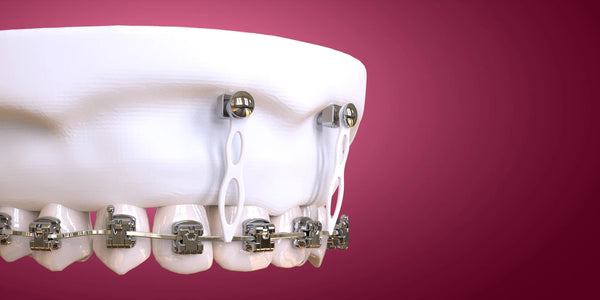 Microimplant Anchorage in Clinical Practice: Beginner to Intermediate Guide
