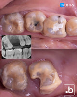 The Biomimetic Concept: Composite Restoration Protocols