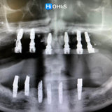 Removable dentures for dentists and technicians