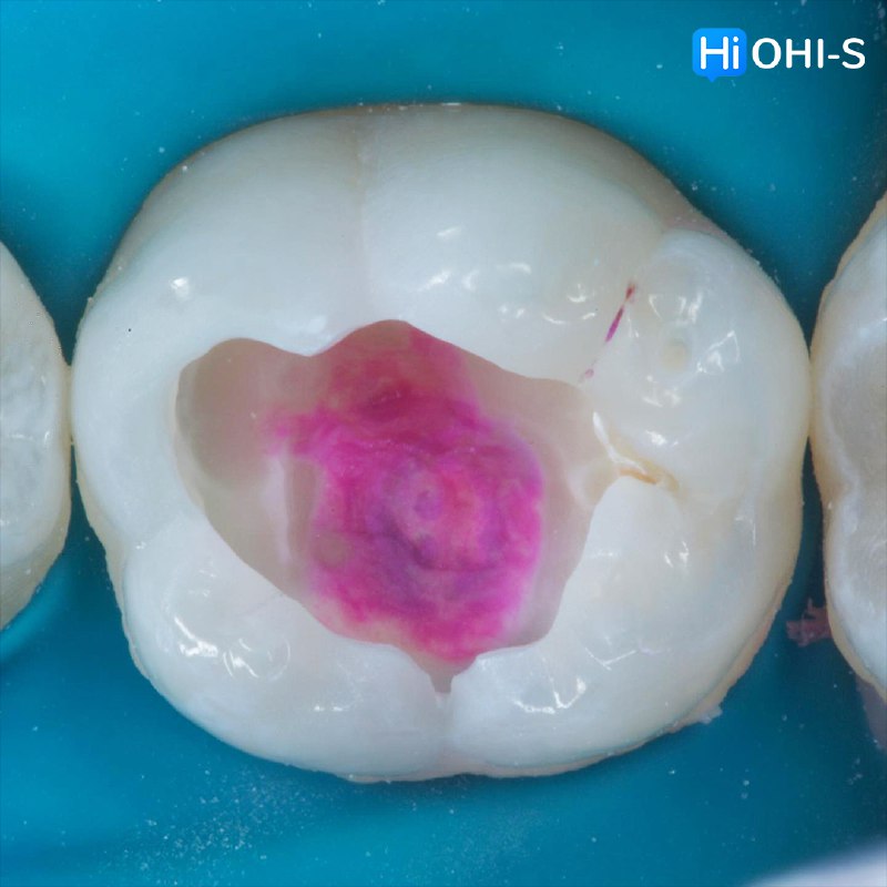 International Schools Working with Composite Restorations