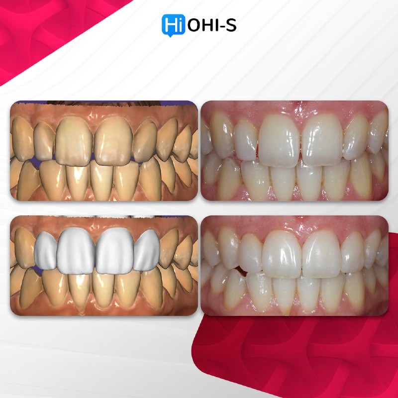 Anterior Veneers: Digital Manufacturing Protocols for Functional and Aesthetic Restorations