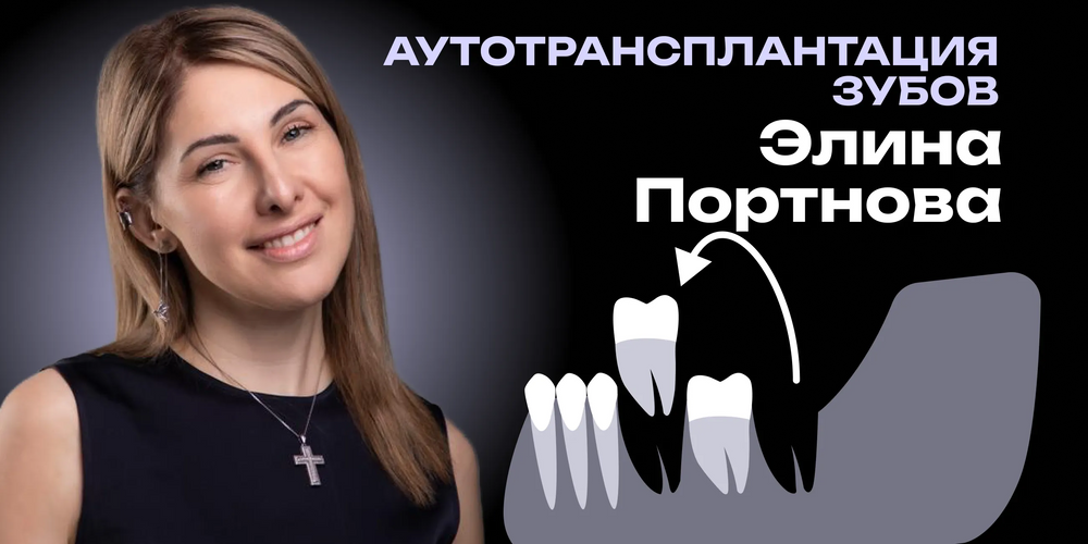 Аутотрансплантация зубов: современная альтернатива имплантации