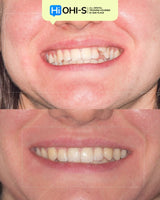 Aligners and Microimplants: Combined Protocol