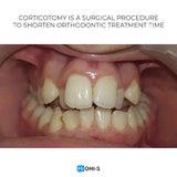 Accelerated Orthodontics: Baruti‑Demiraqi Corticotomy Protocol