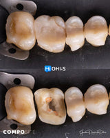 The Biomimetic Concept: Composite Restoration Protocols