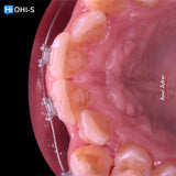 Damon 2.0. How to treat all common malocclusions