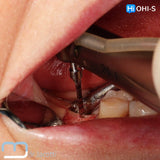 Predictable Sinus Lift