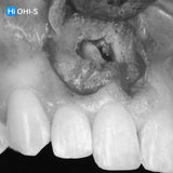 Apical Surgery: For Endodontists and Surgeons