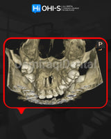 Apical Surgery: For Endodontists and Surgeons