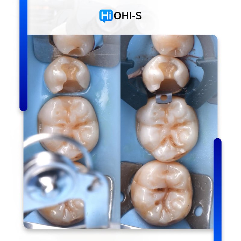 International Schools Working with Composite Restorations