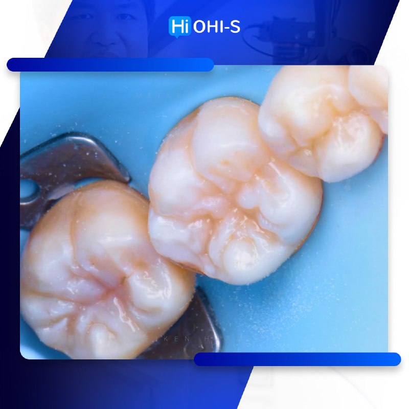 International Schools Working with Composite Restorations