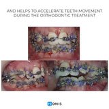 Accelerated Orthodontics: Baruti‑Demiraqi Corticotomy Protocol