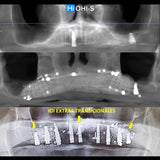 Bone Augmentation: Current Techniques