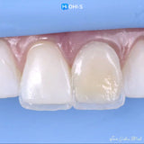 The Biomimetic Concept: Composite Restoration Protocols